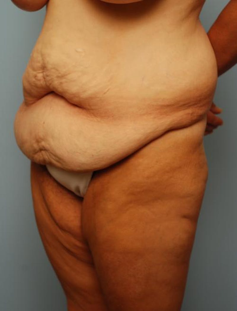 Tummy Tuck Before & After Gallery - Patient 392265 - Image 7