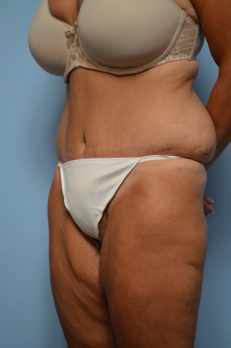 Tummy Tuck Before & After Gallery - Patient 392265 - Image 8