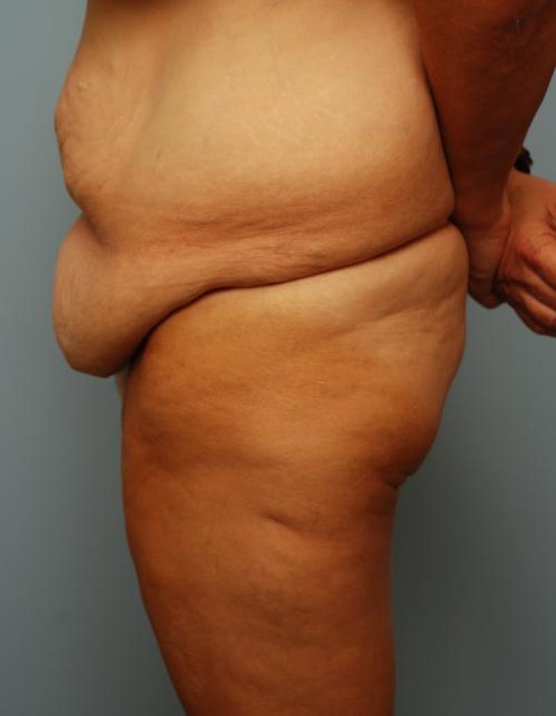 Tummy Tuck Before & After Gallery - Patient 392265 - Image 9