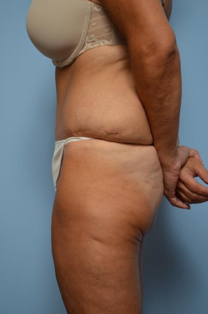 Tummy Tuck Before & After Gallery - Patient 392265 - Image 10