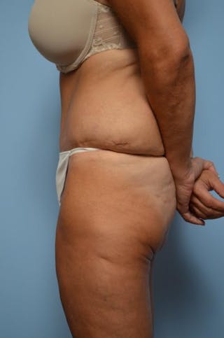 Tummy Tuck Before & After Gallery - Patient 392265 - Image 10