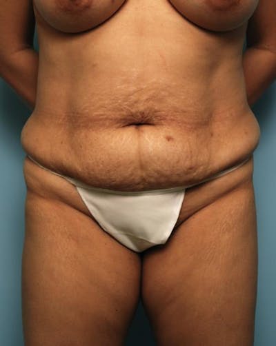 Tummy Tuck Before & After Gallery - Patient 403407 - Image 1