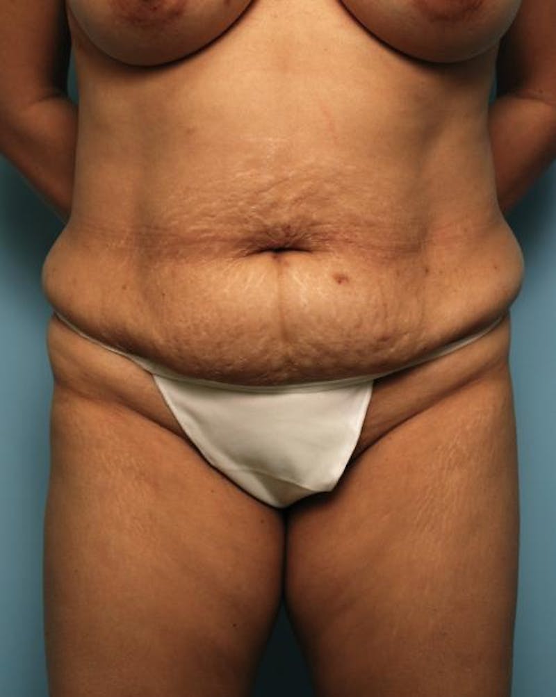 Tummy Tuck Before & After Gallery - Patient 403407 - Image 1