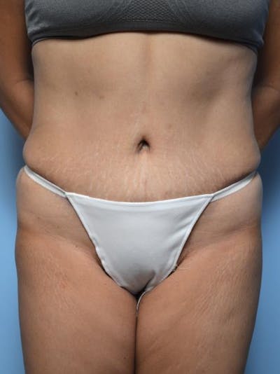 Tummy Tuck Before & After Gallery - Patient 403407 - Image 2