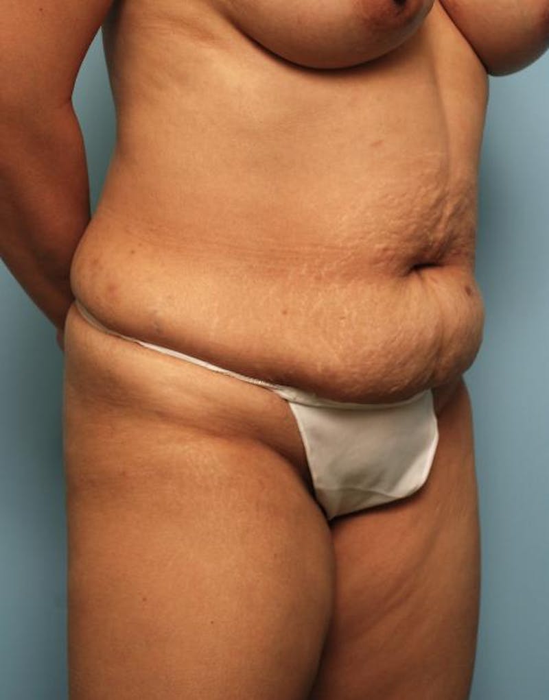 Tummy Tuck Before & After Gallery - Patient 403407 - Image 3