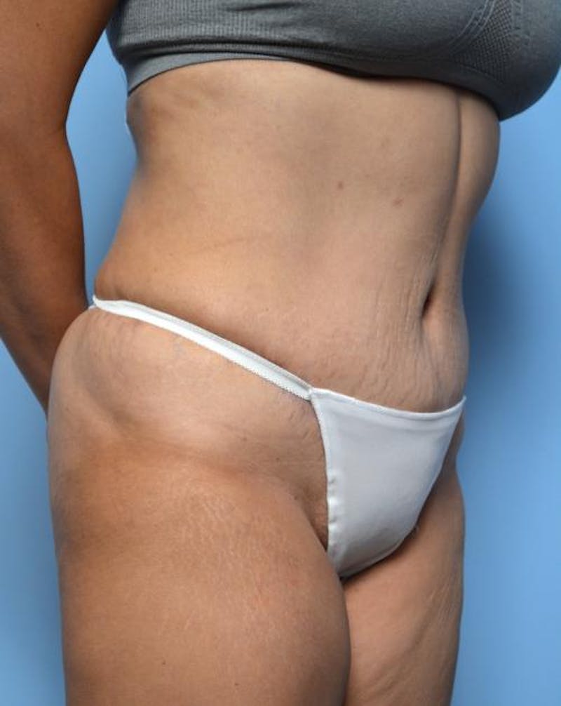Tummy Tuck Before & After Gallery - Patient 403407 - Image 4