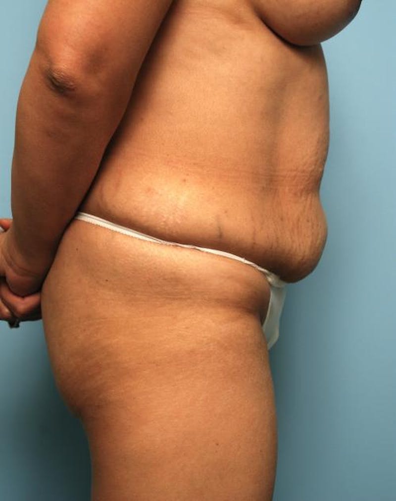 Tummy Tuck Before & After Gallery - Patient 403407 - Image 5