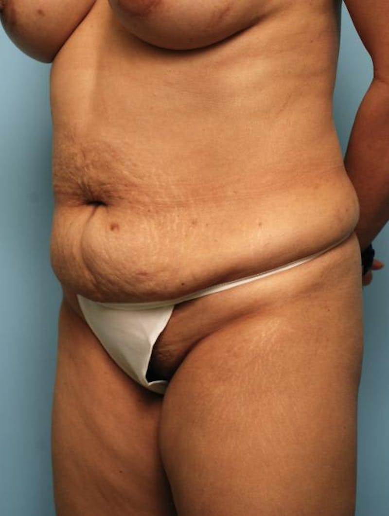 Tummy Tuck Before & After Gallery - Patient 403407 - Image 7