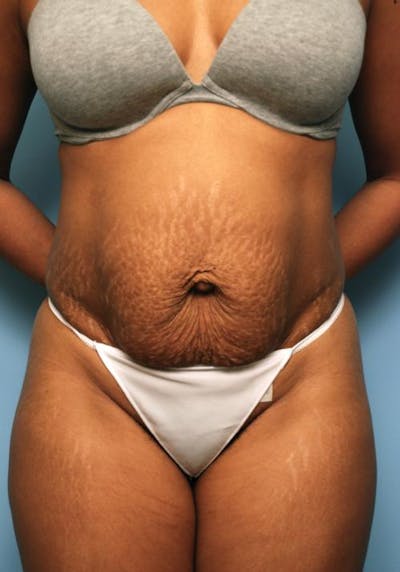 Tummy Tuck Before & After Gallery - Patient 373718 - Image 1