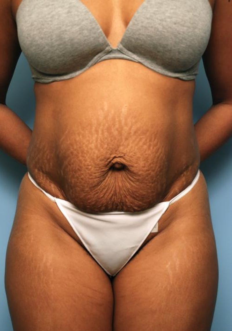 Tummy Tuck Before & After Gallery - Patient 373718 - Image 1