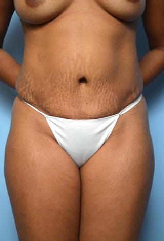 Tummy Tuck Before & After Gallery - Patient 373718 - Image 2