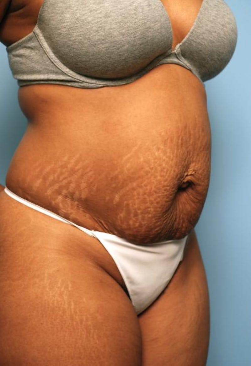 Tummy Tuck Before & After Gallery - Patient 373718 - Image 3