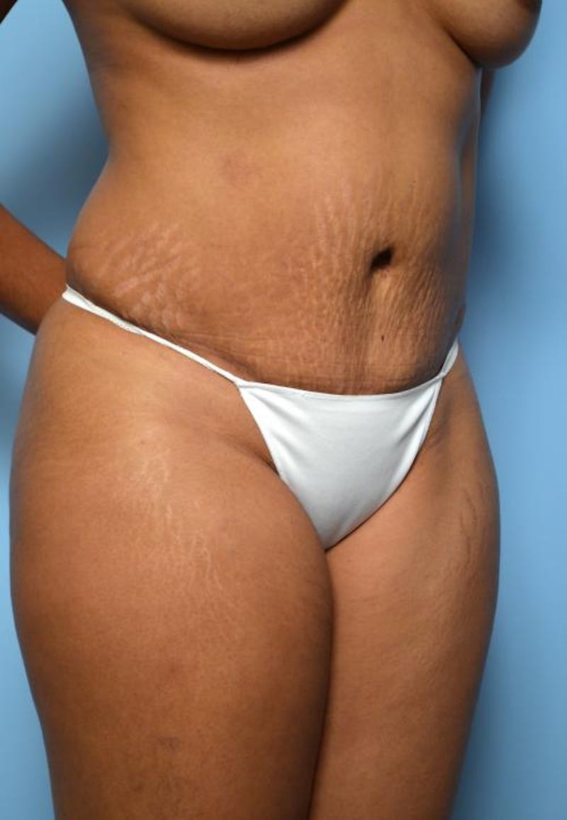 Tummy Tuck Before & After Gallery - Patient 373718 - Image 4
