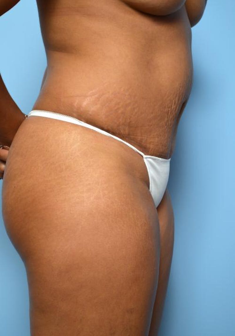Tummy Tuck Before & After Gallery - Patient 373718 - Image 6