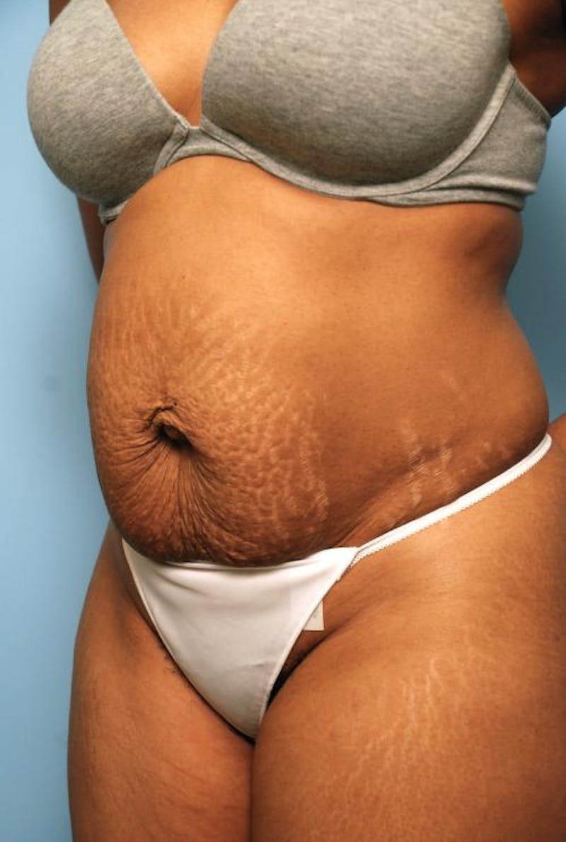 Tummy Tuck Before & After Gallery - Patient 373718 - Image 7