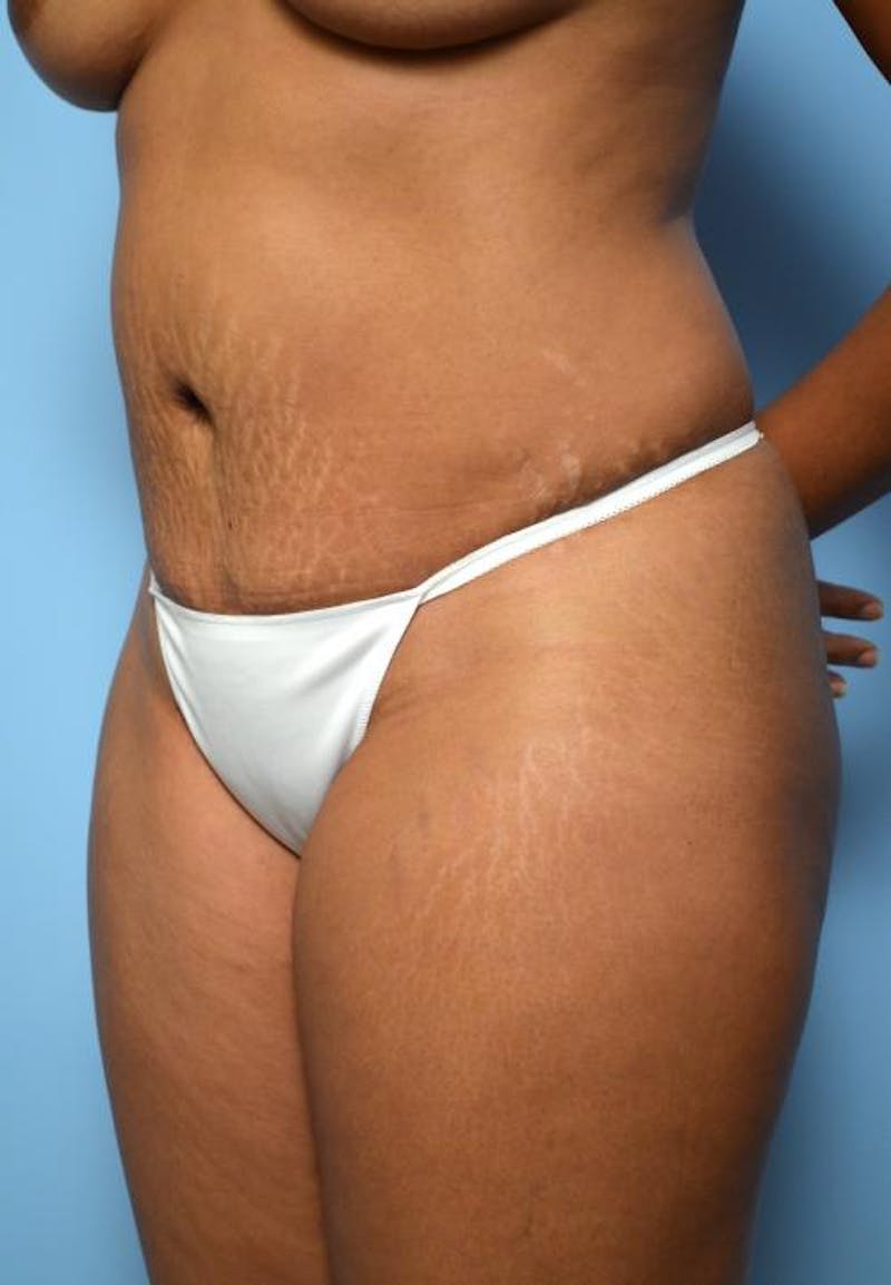 Tummy Tuck Before & After Gallery - Patient 373718 - Image 8