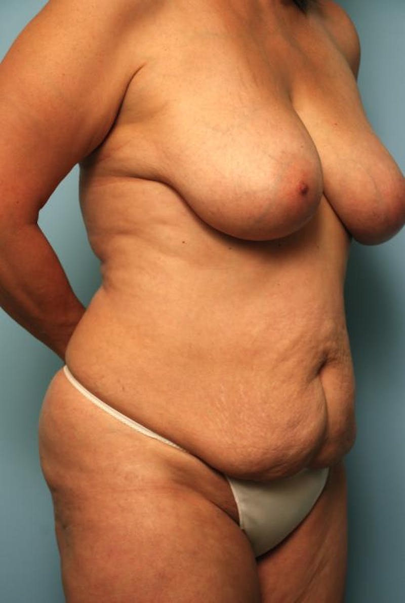 Tummy Tuck Before & After Gallery - Patient 371465 - Image 3