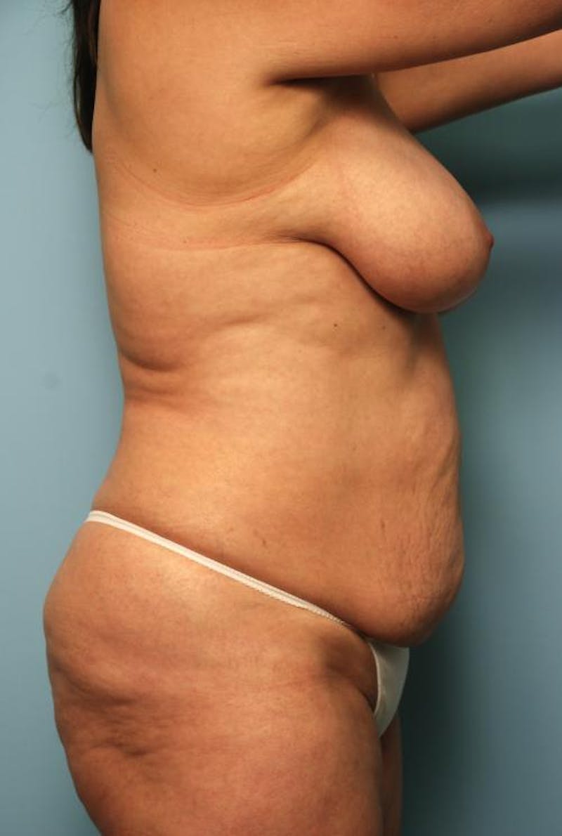 Tummy Tuck Before & After Gallery - Patient 371465 - Image 5