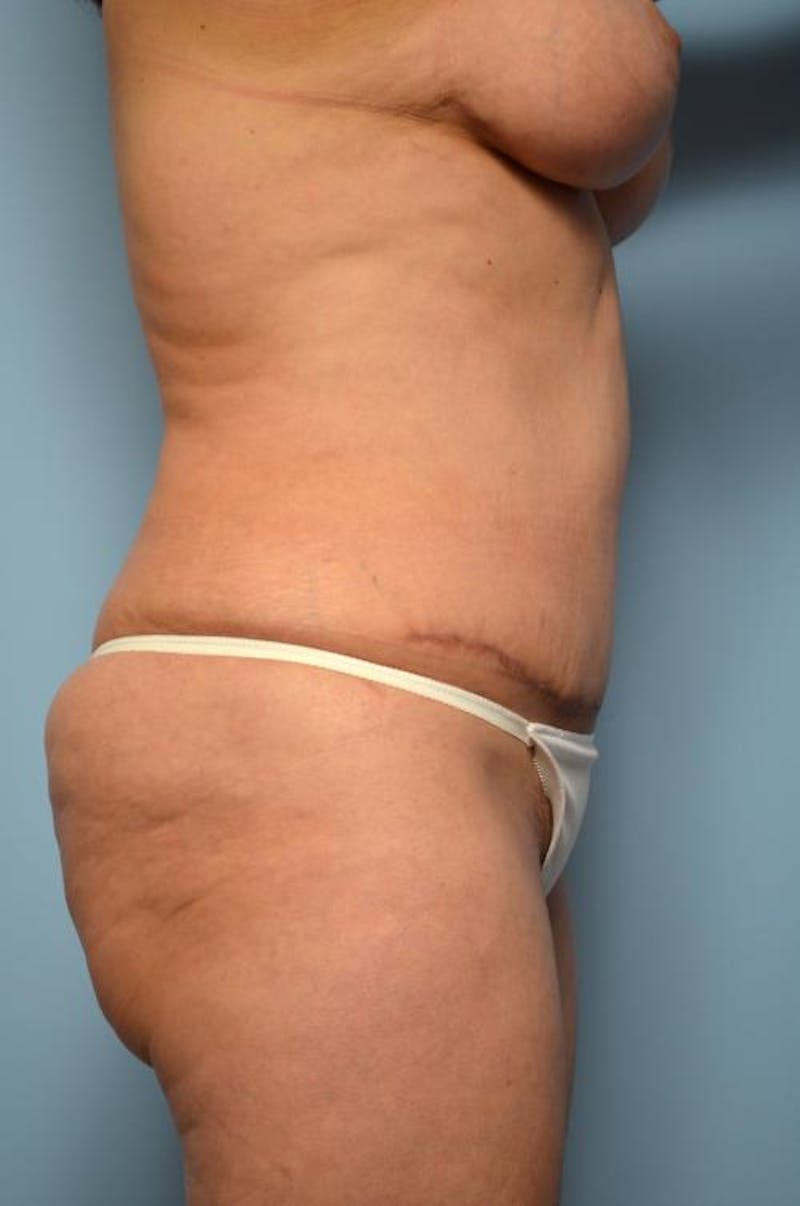 Tummy Tuck Before & After Gallery - Patient 371465 - Image 6