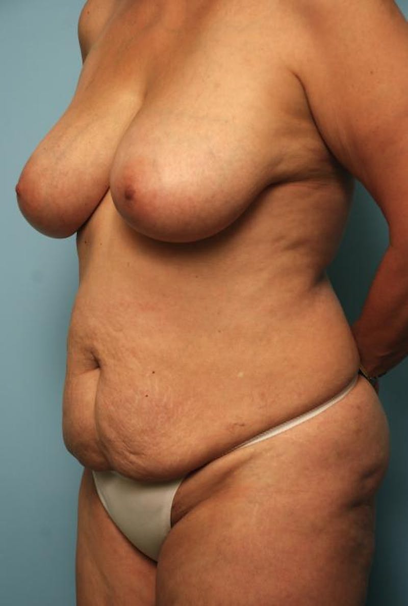 Tummy Tuck Before & After Gallery - Patient 371465 - Image 7