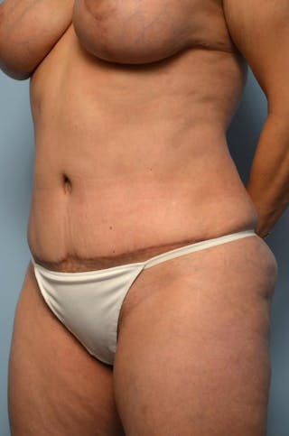 Tummy Tuck Before & After Gallery - Patient 371465 - Image 8