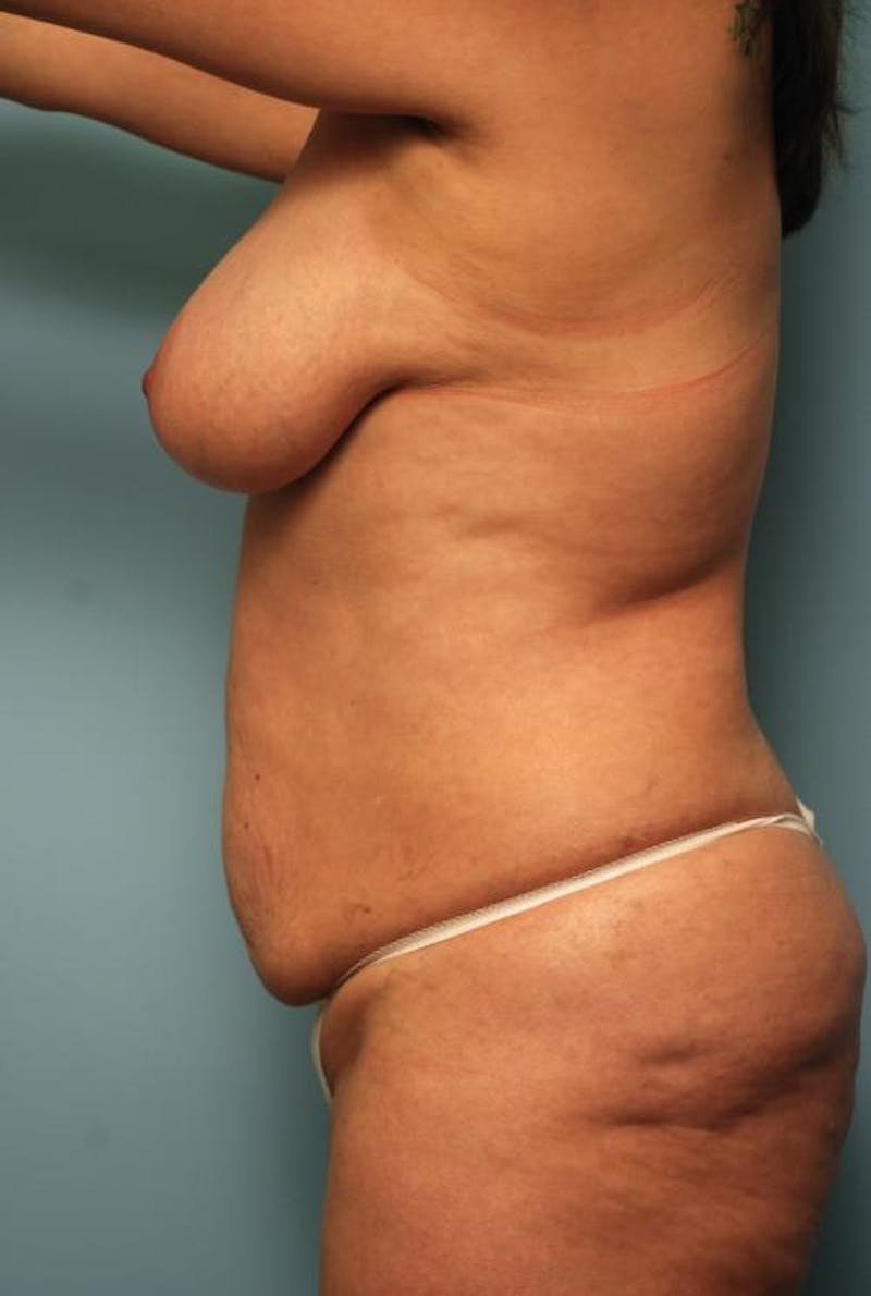 Tummy Tuck Before & After Gallery - Patient 371465 - Image 9