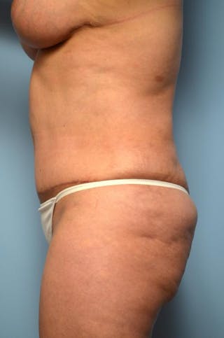 Tummy Tuck Before & After Gallery - Patient 371465 - Image 10