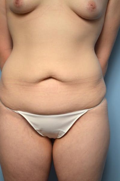 Tummy Tuck Before & After Gallery - Patient 295043 - Image 1