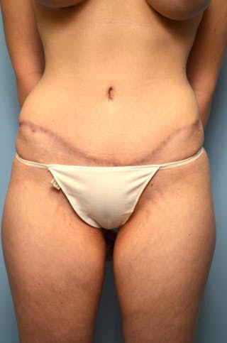 Tummy Tuck Before & After Gallery - Patient 295043 - Image 2