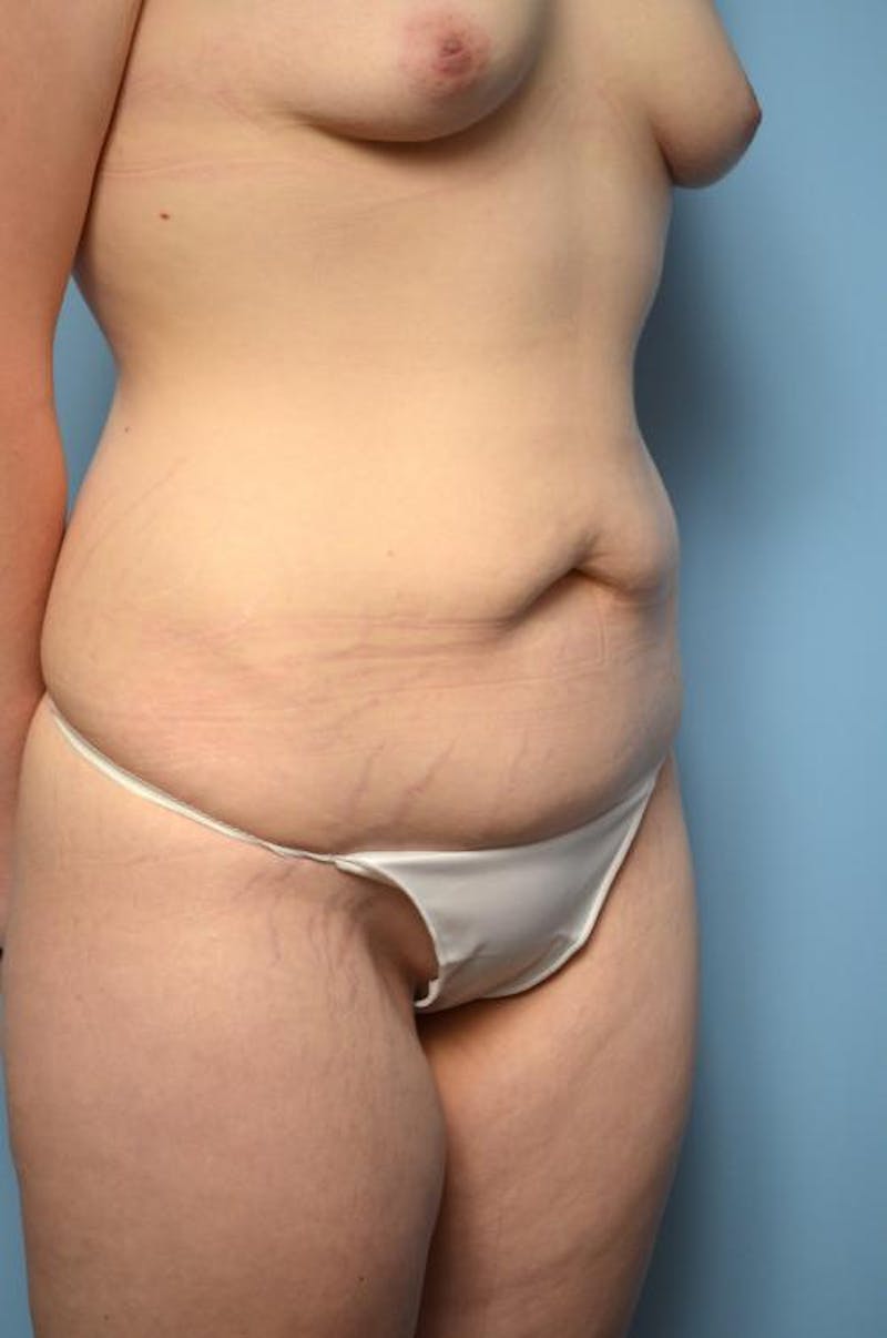Tummy Tuck Before & After Gallery - Patient 295043 - Image 3