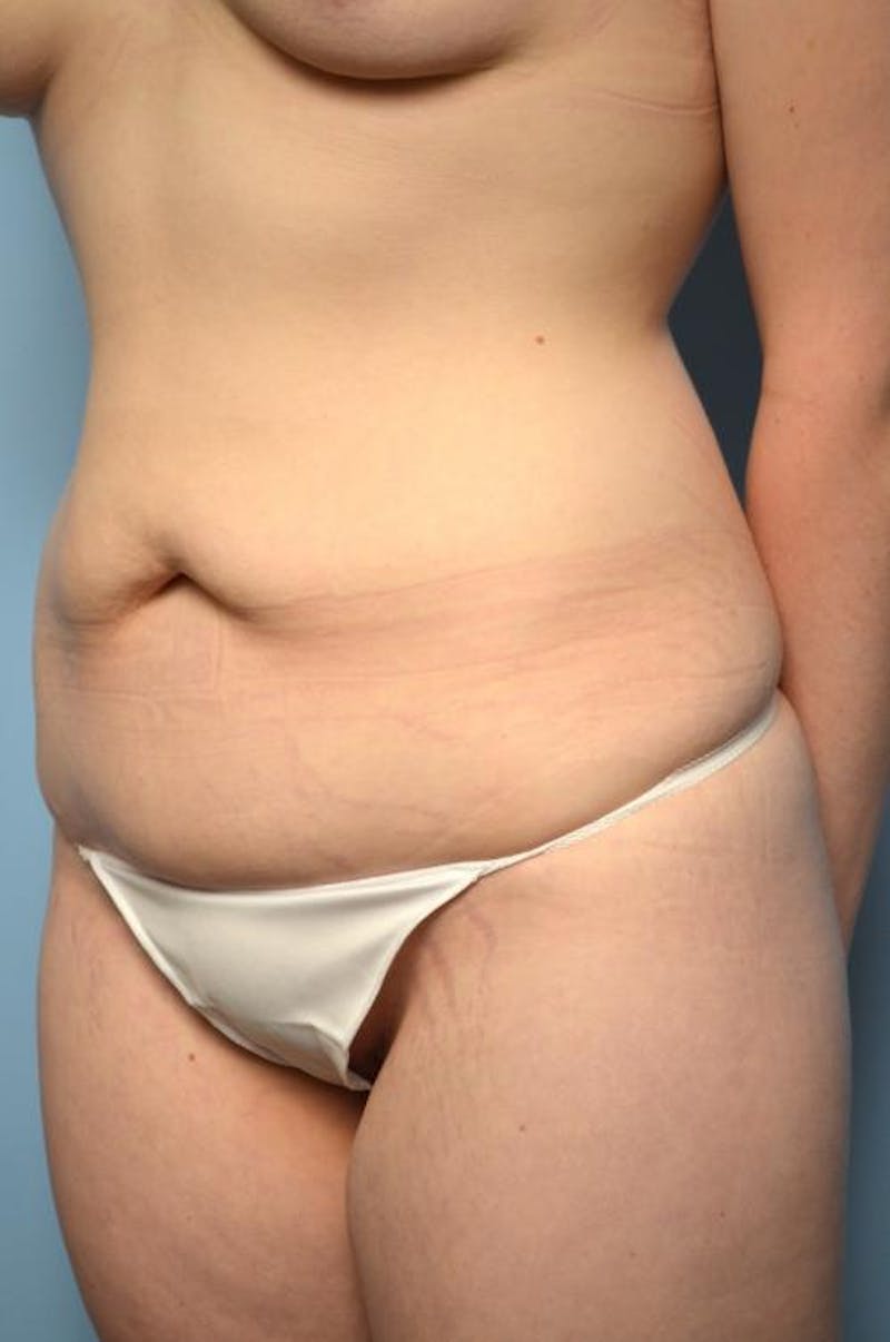 Tummy Tuck Before & After Gallery - Patient 295043 - Image 7