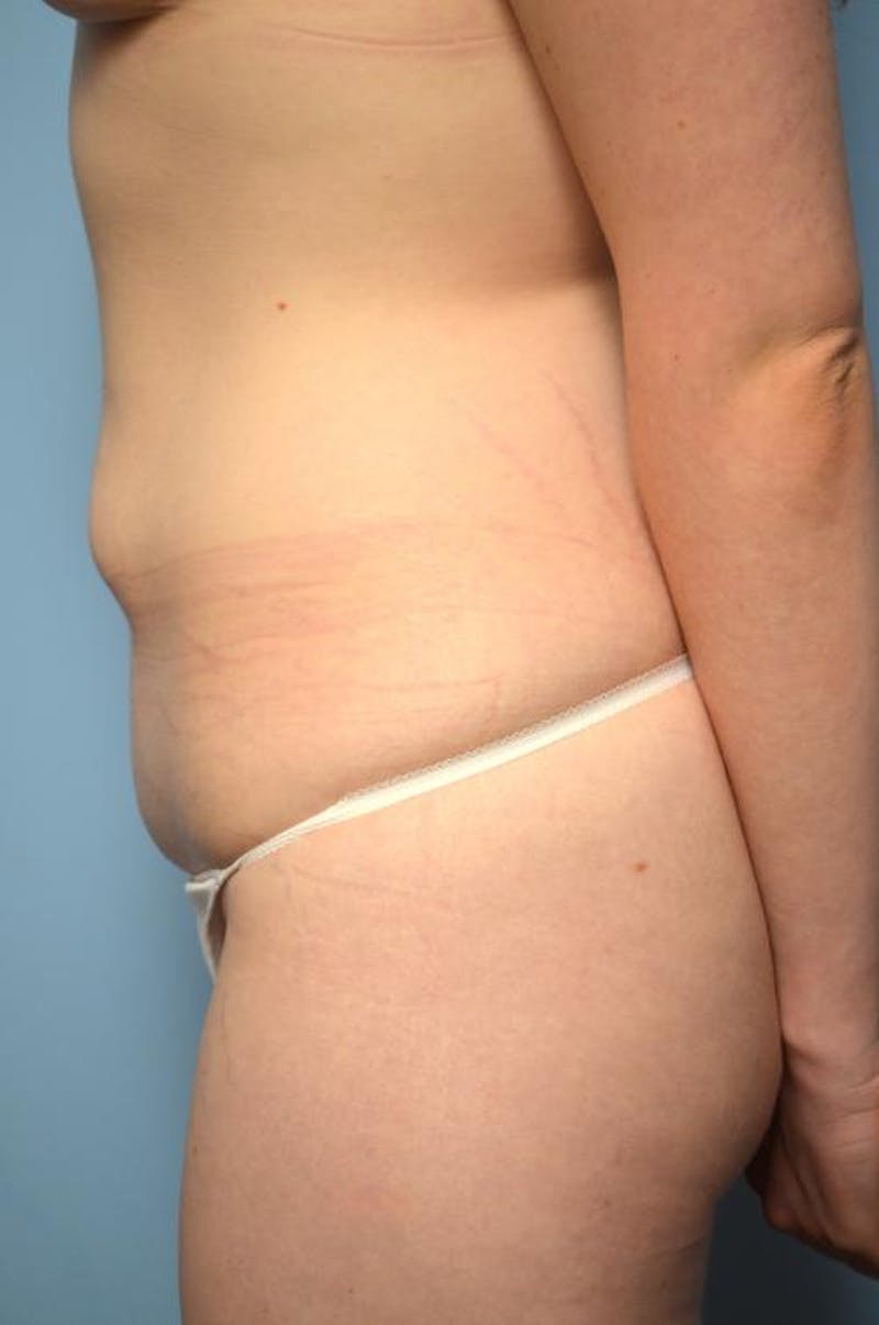 Tummy Tuck Before & After Gallery - Patient 295043 - Image 9