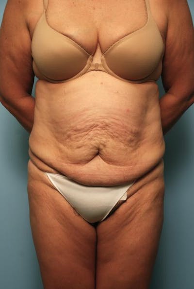 Tummy Tuck Before & After Gallery - Patient 375372 - Image 1