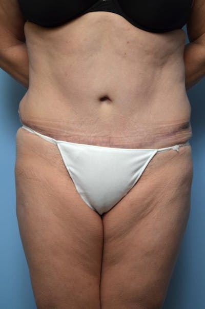 Tummy Tuck Before & After Gallery - Patient 375372 - Image 2