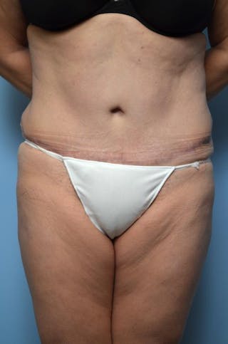 Tummy Tuck Before & After Gallery - Patient 375372 - Image 2