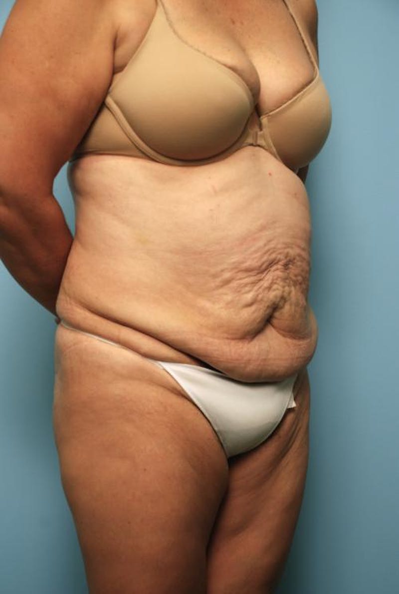 Tummy Tuck Before & After Gallery - Patient 375372 - Image 3
