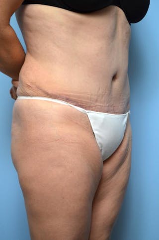 Tummy Tuck Before & After Gallery - Patient 375372 - Image 4