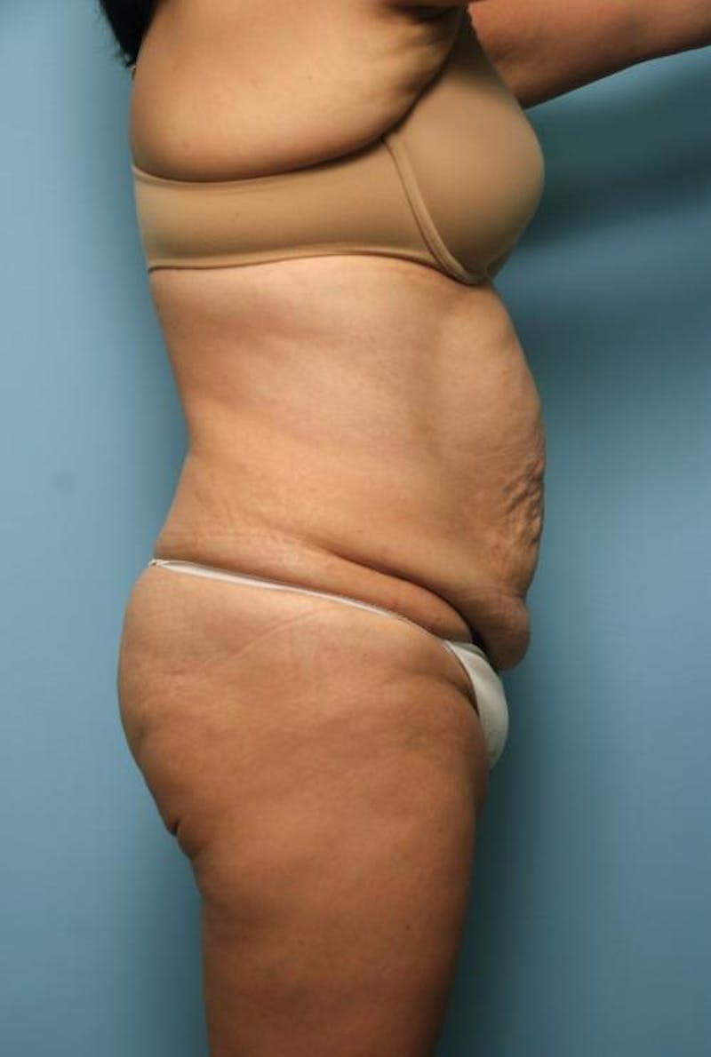 Tummy Tuck Before & After Gallery - Patient 375372 - Image 5