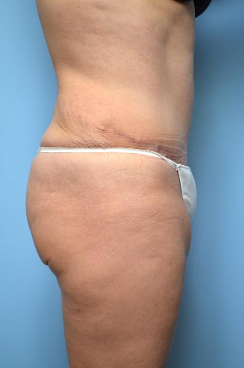 Tummy Tuck Before & After Gallery - Patient 375372 - Image 6