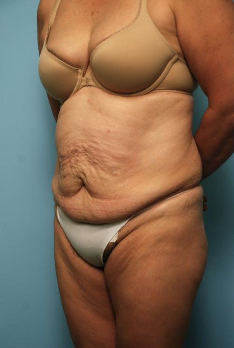 Tummy Tuck Before & After Gallery - Patient 375372 - Image 7