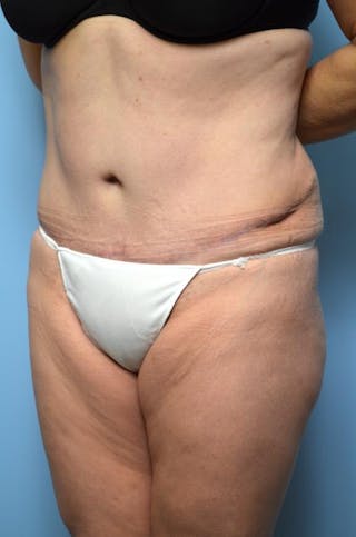 Tummy Tuck Before & After Gallery - Patient 375372 - Image 8