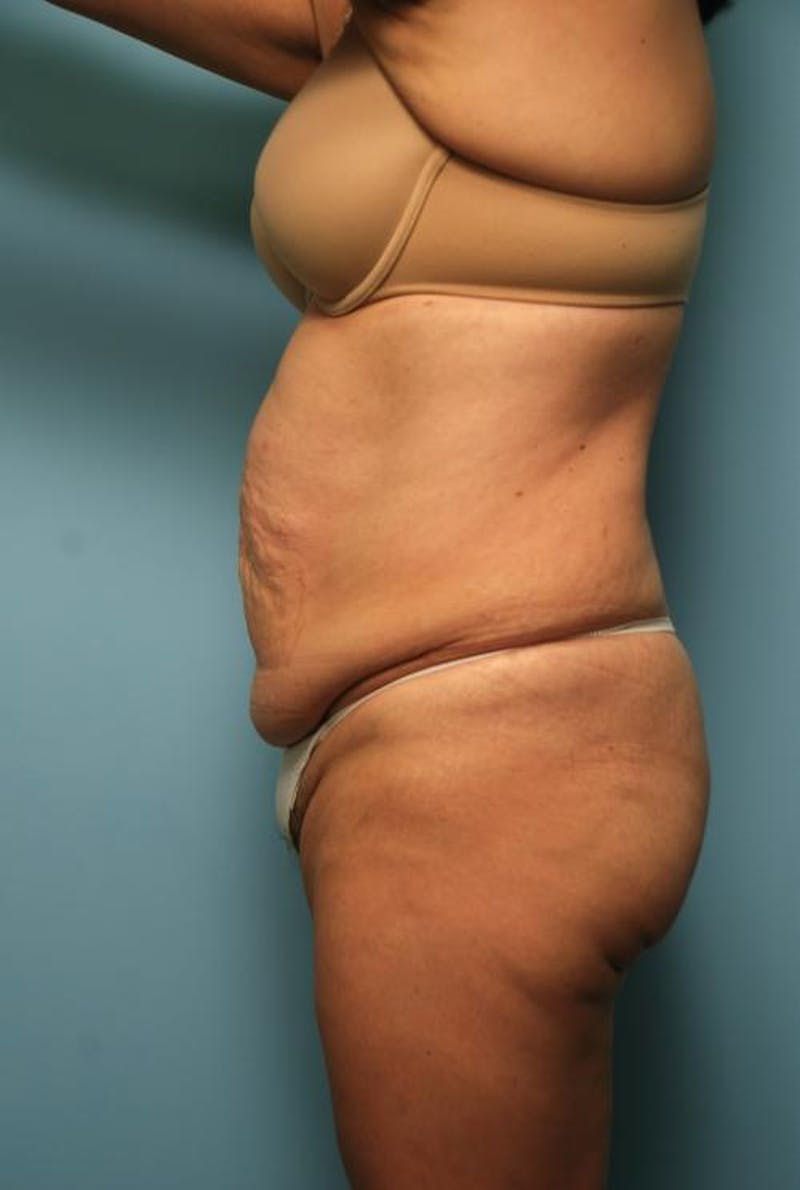 Tummy Tuck Before & After Gallery - Patient 375372 - Image 9