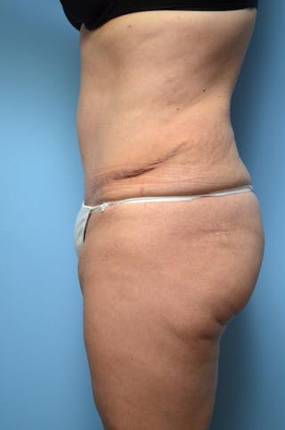Tummy Tuck Before & After Gallery - Patient 375372 - Image 10
