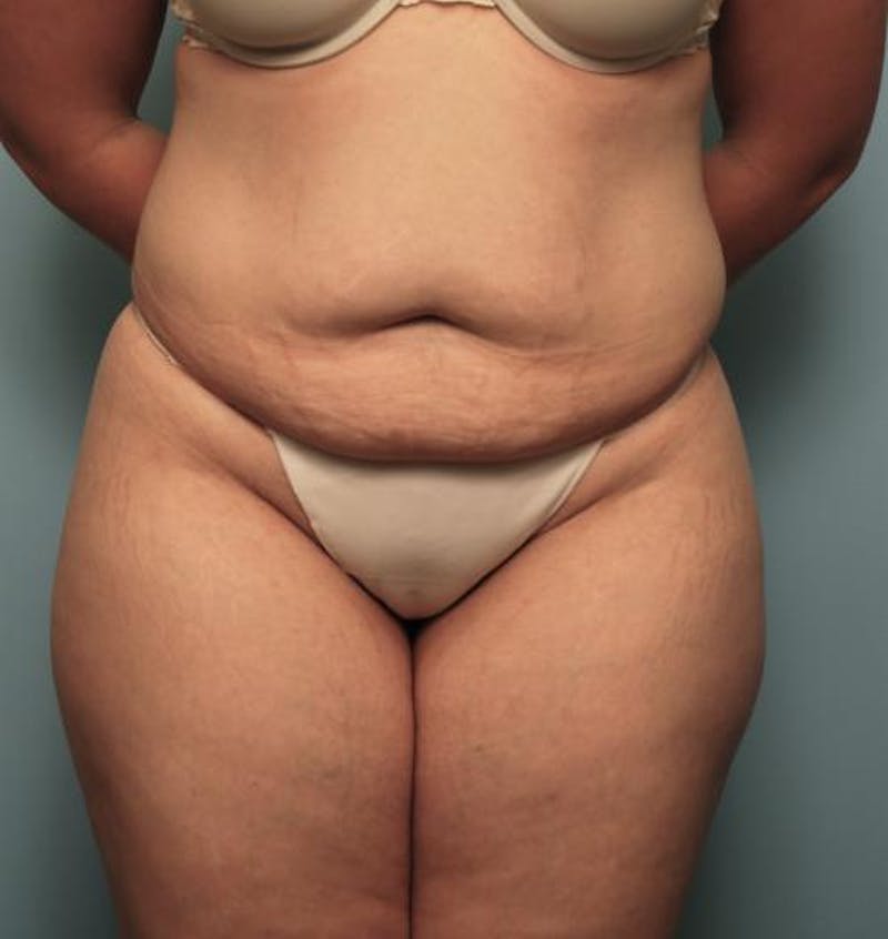 Tummy Tuck Before & After Gallery - Patient 148557 - Image 1