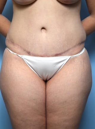 Tummy Tuck Before & After Gallery - Patient 148557 - Image 2