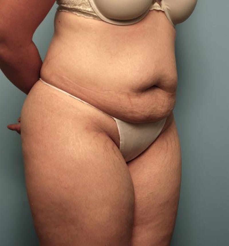 Tummy Tuck Before & After Gallery - Patient 148557 - Image 3