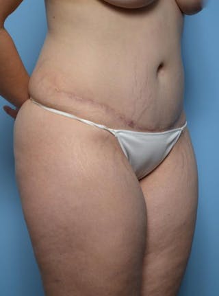 Tummy Tuck Before & After Gallery - Patient 148557 - Image 4