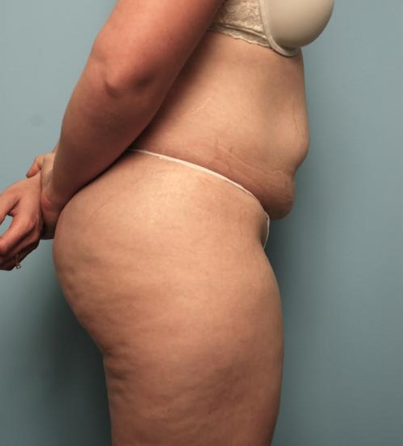 Tummy Tuck Before & After Gallery - Patient 148557 - Image 5