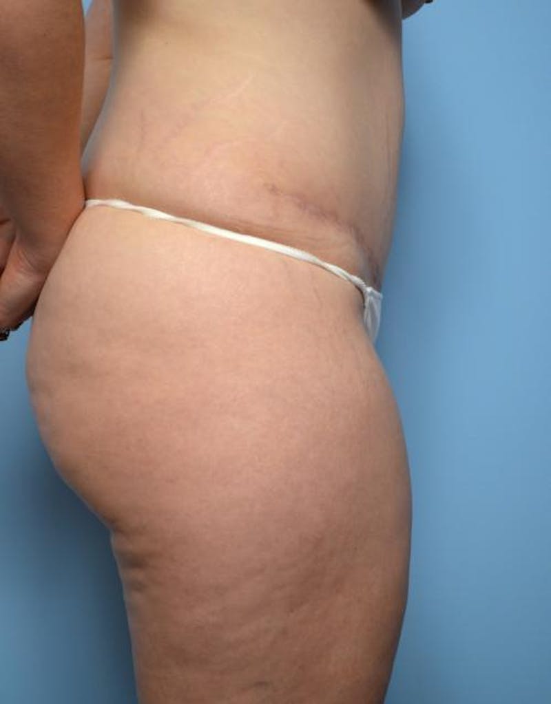Tummy Tuck Before & After Gallery - Patient 148557 - Image 6