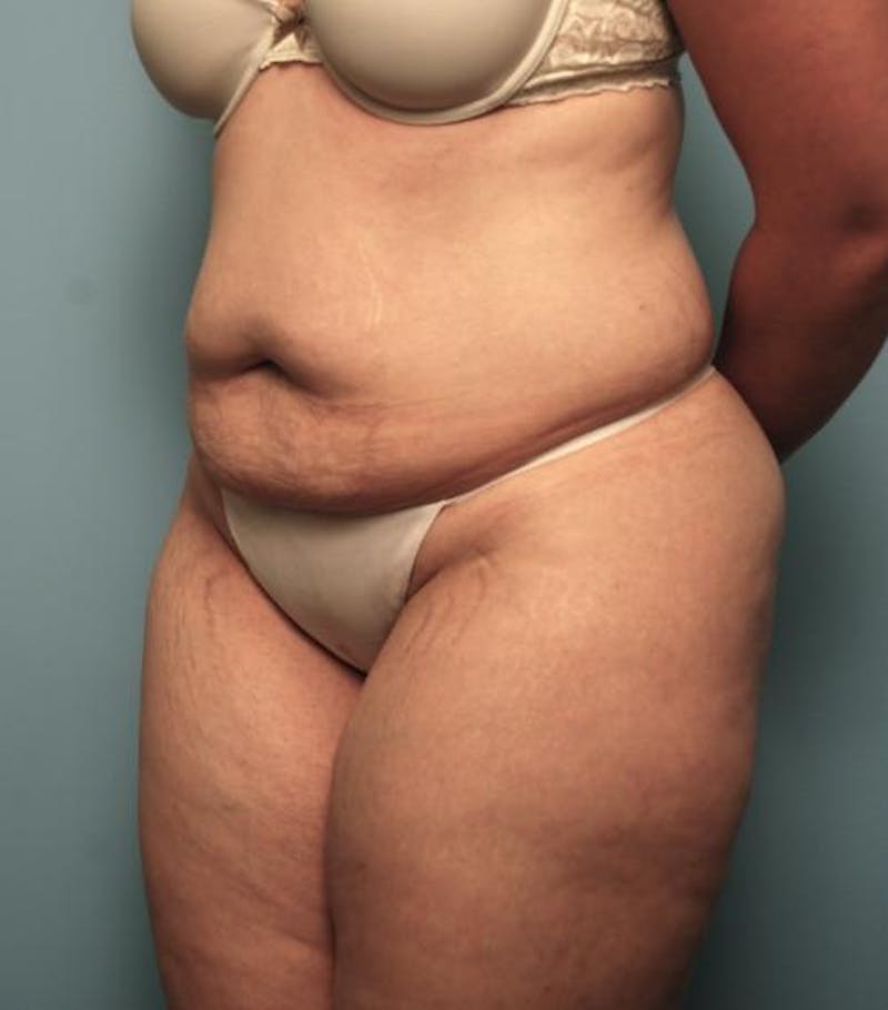 Tummy Tuck Before & After Gallery - Patient 148557 - Image 7